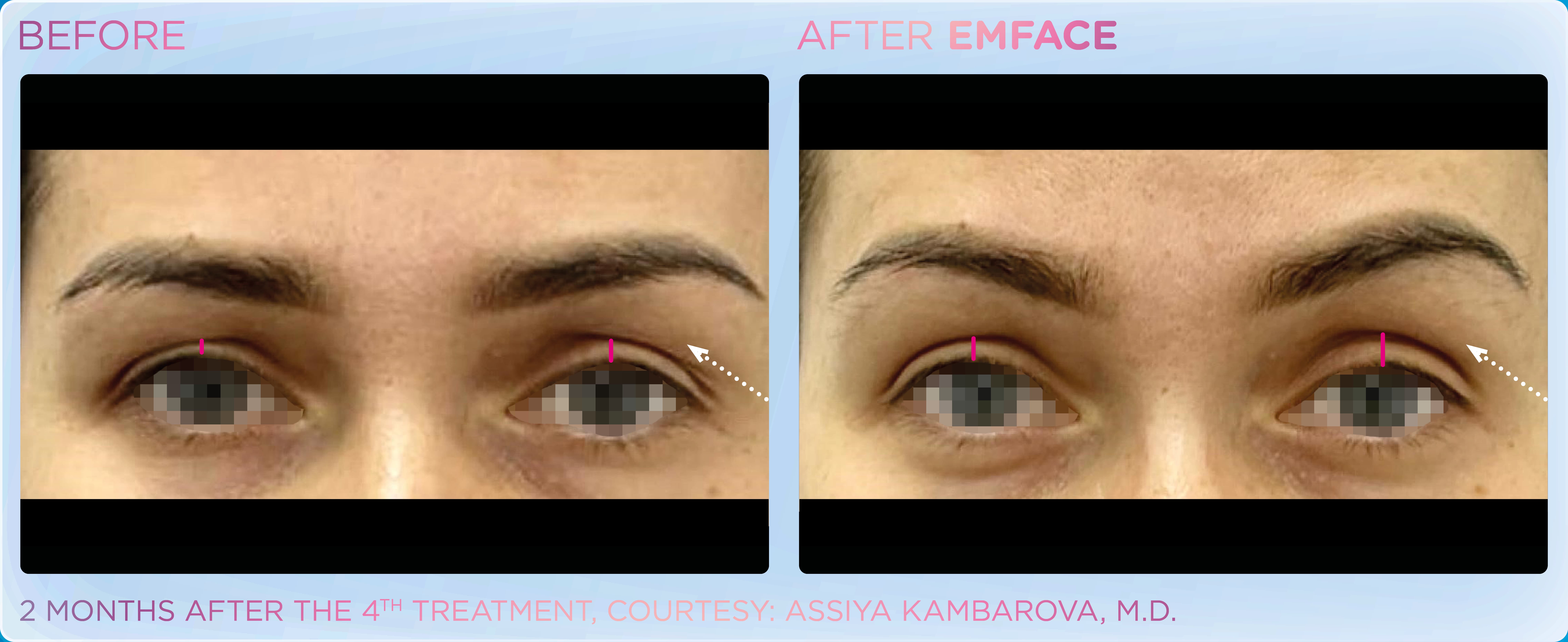 Emface eye area treatment