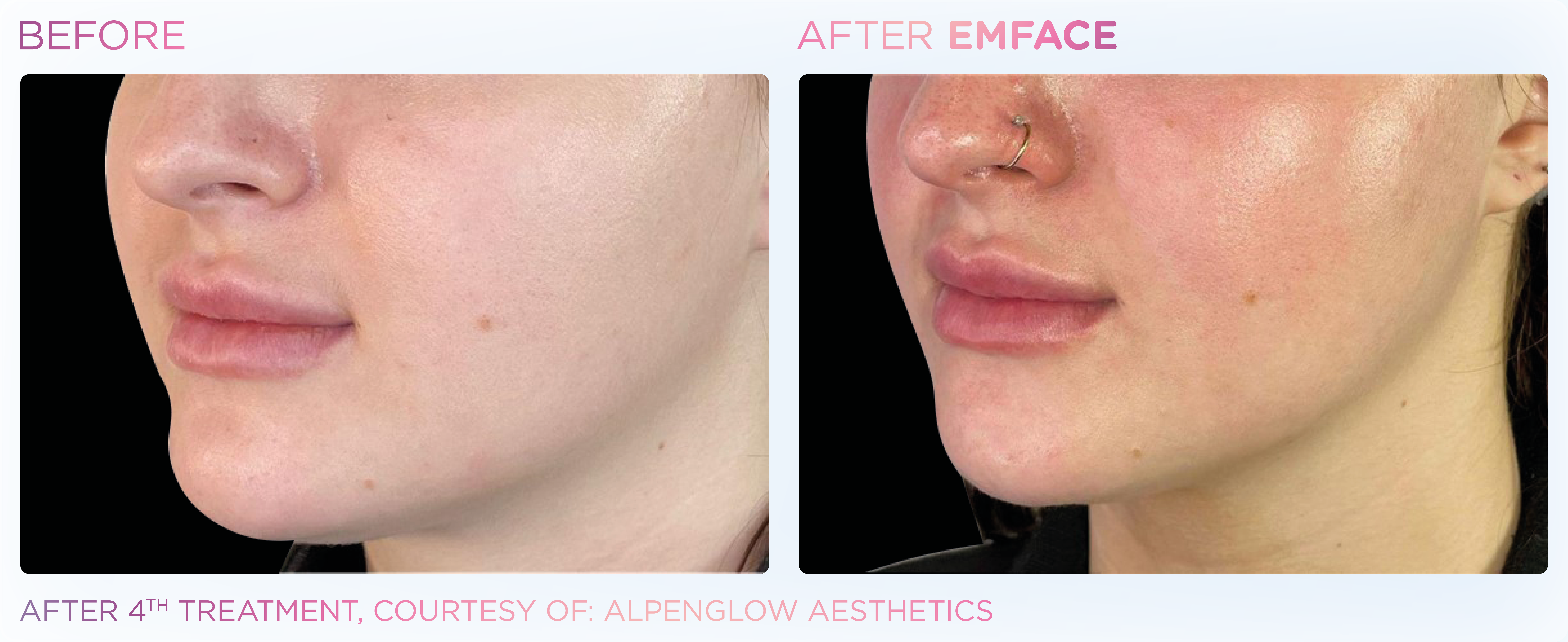 Emface jawline treatment