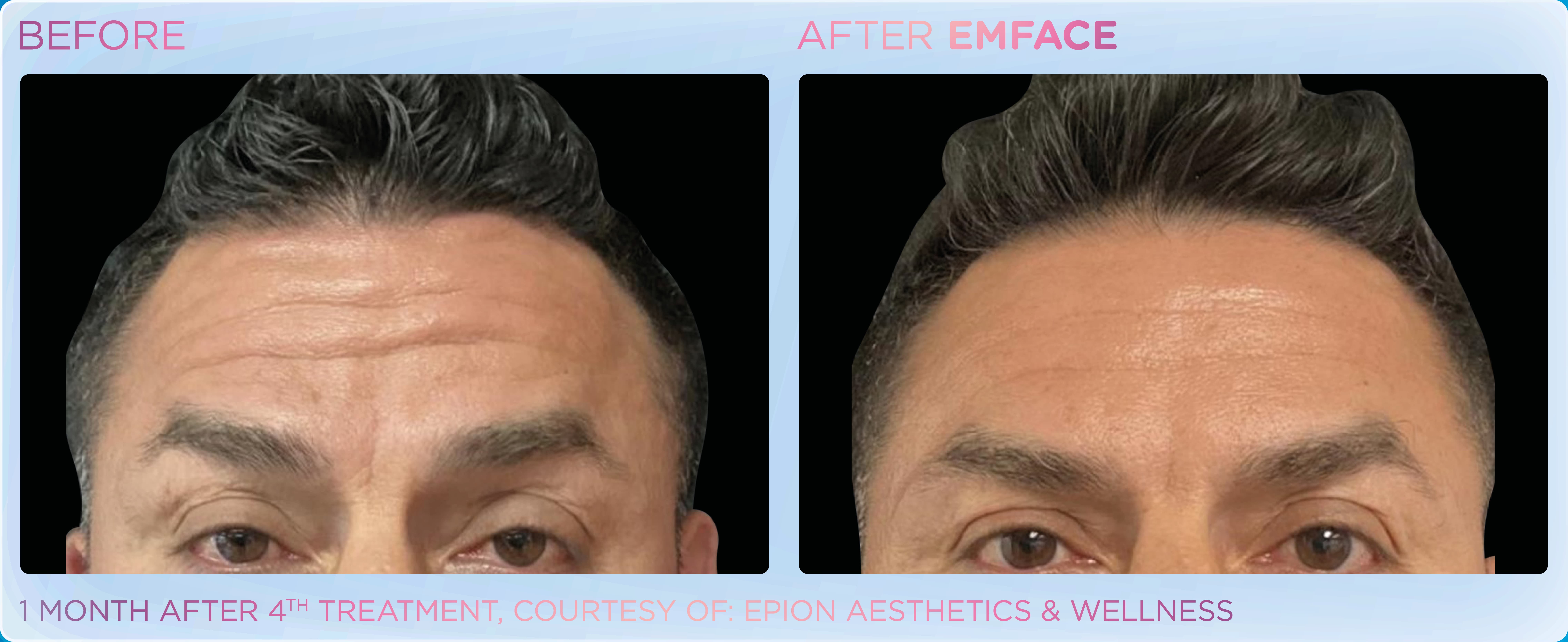 Emface forehead treatment
