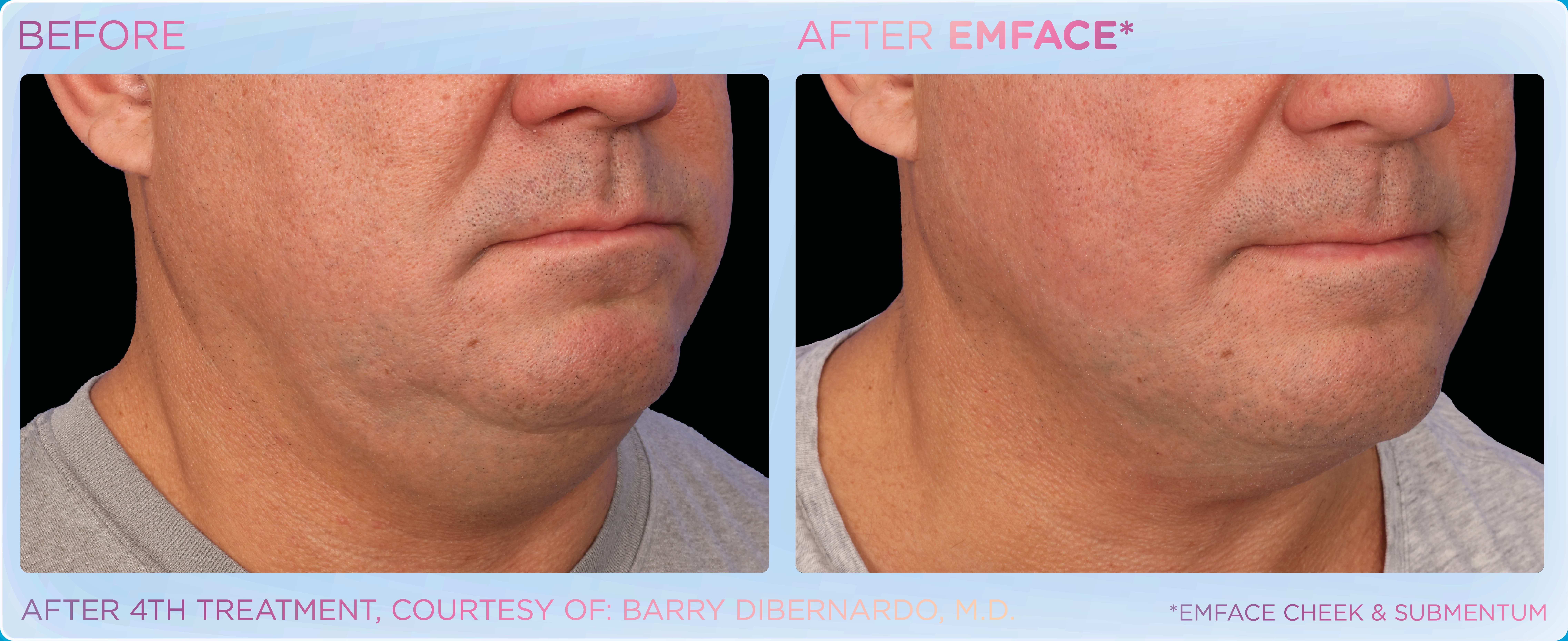 Emface submentum treatment