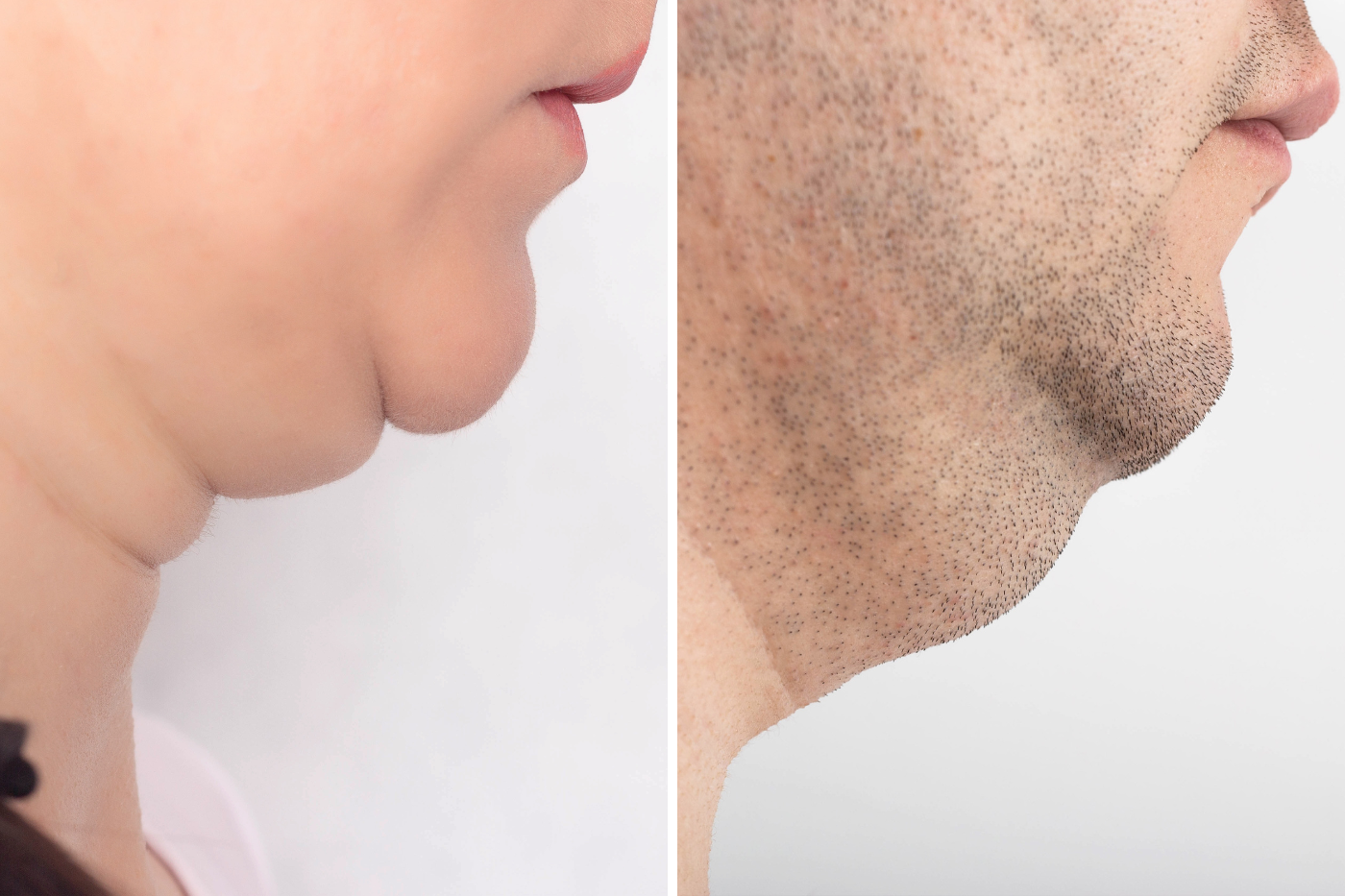Double chin and jawline change illustration