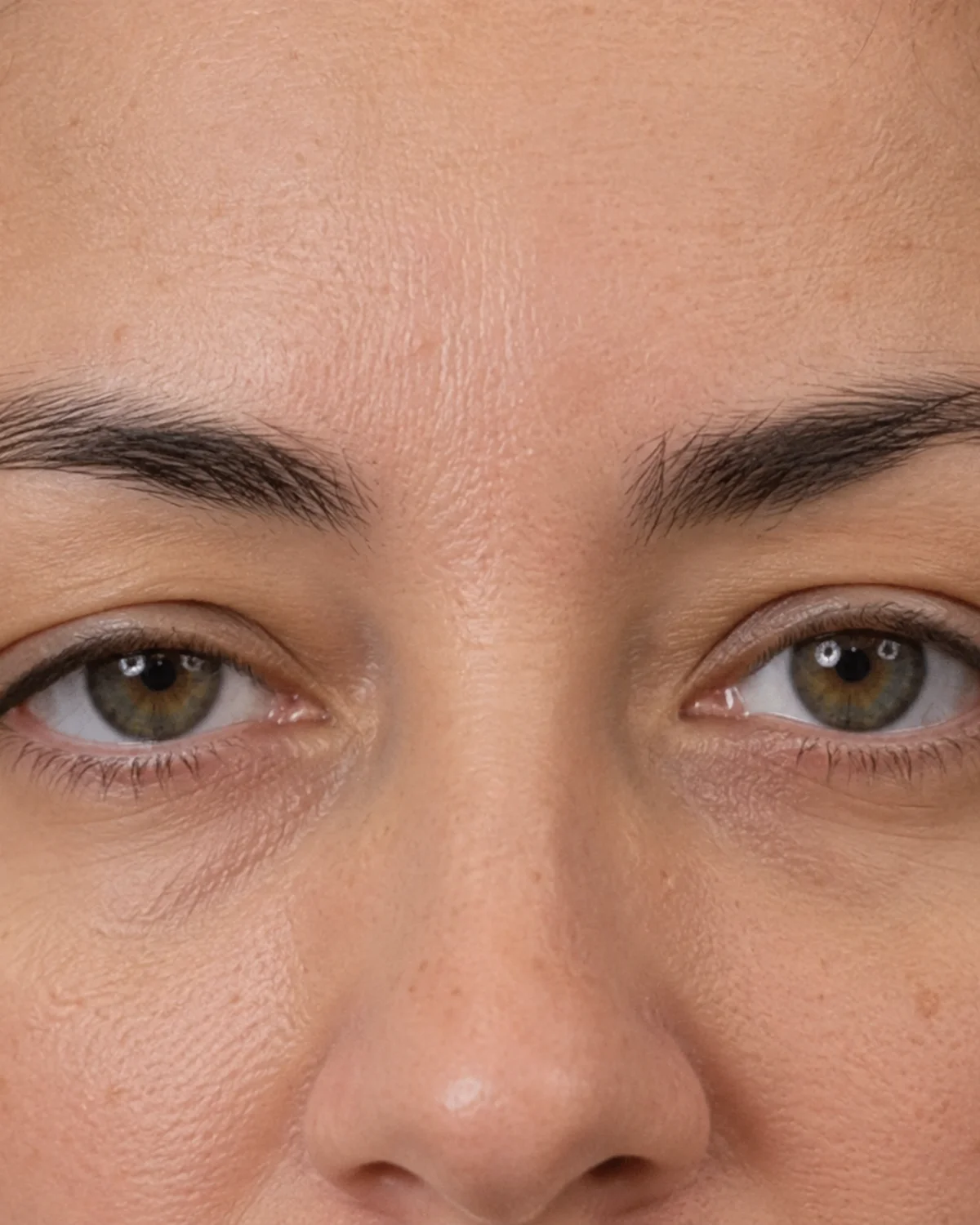 Close-up of eye area showing early periocular changes